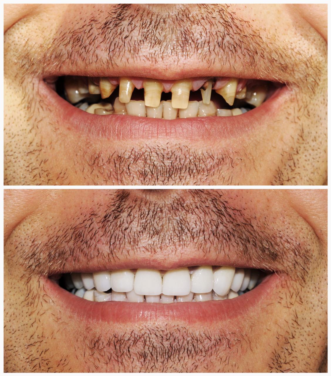 Full Mouth Reconstruction in Mira Road